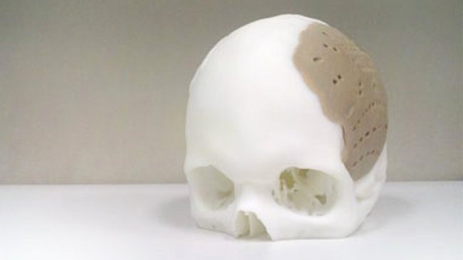 3D Skull Implant